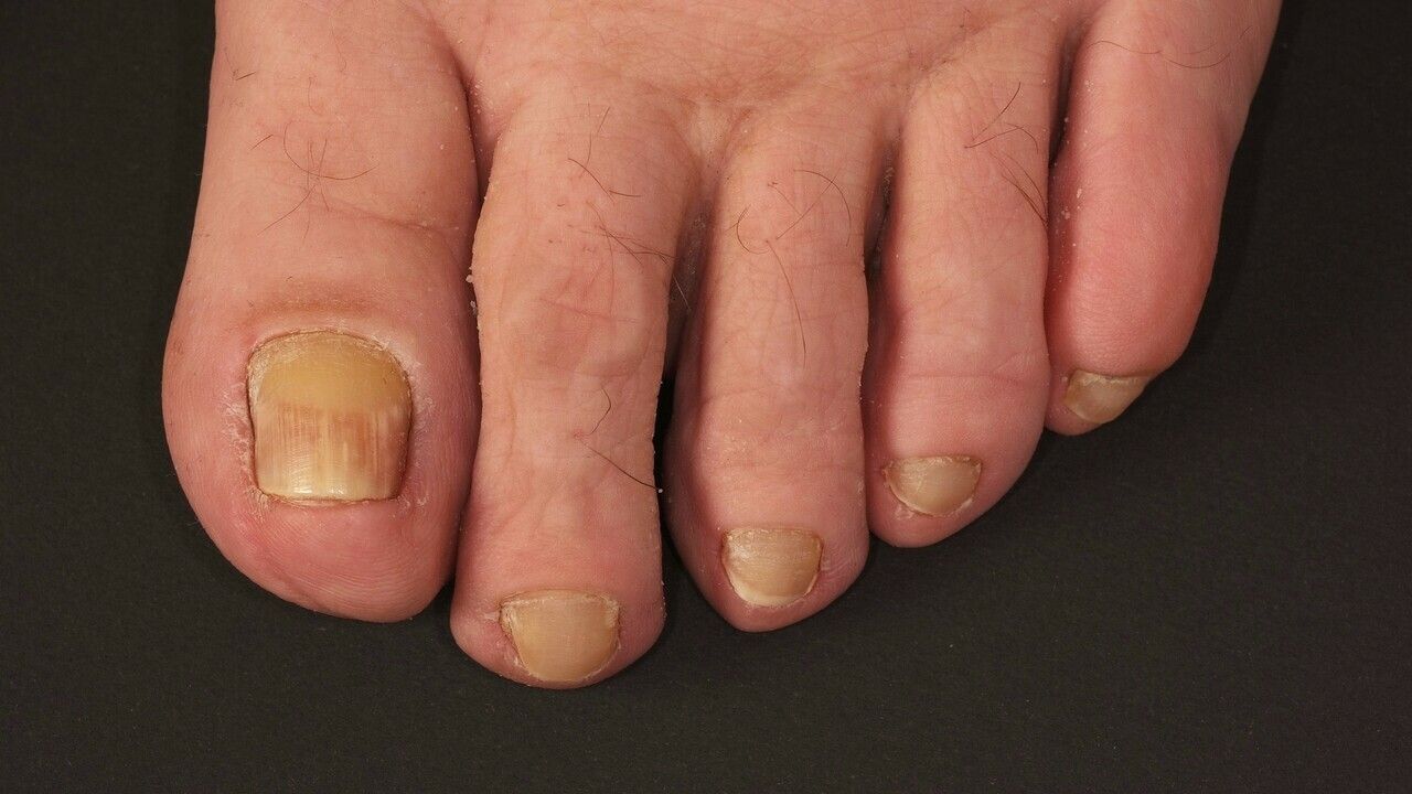 Yellow-nail syndrome - Altmeyers Encyclopedia - Department Dermatology