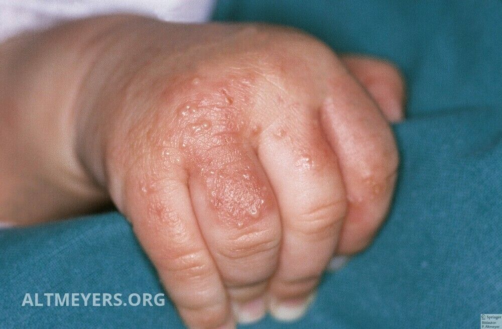 Akropustulose Infantile Altmeyers Enzyklopadie Fachbereich Dermatologie
