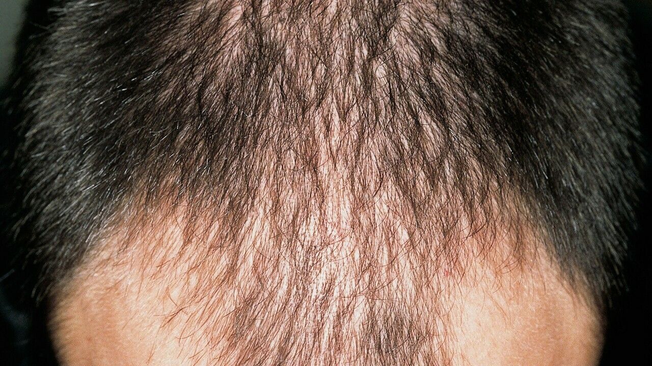 Alopecia Androgenetica Beim Mann Altmeyers Enzyklopadie Fachbereich Dermatologie