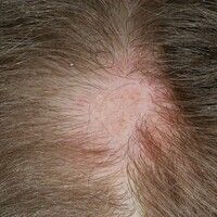 Alopecia scarring Images - Altmeyers Encyclopedia - Department Dermatology