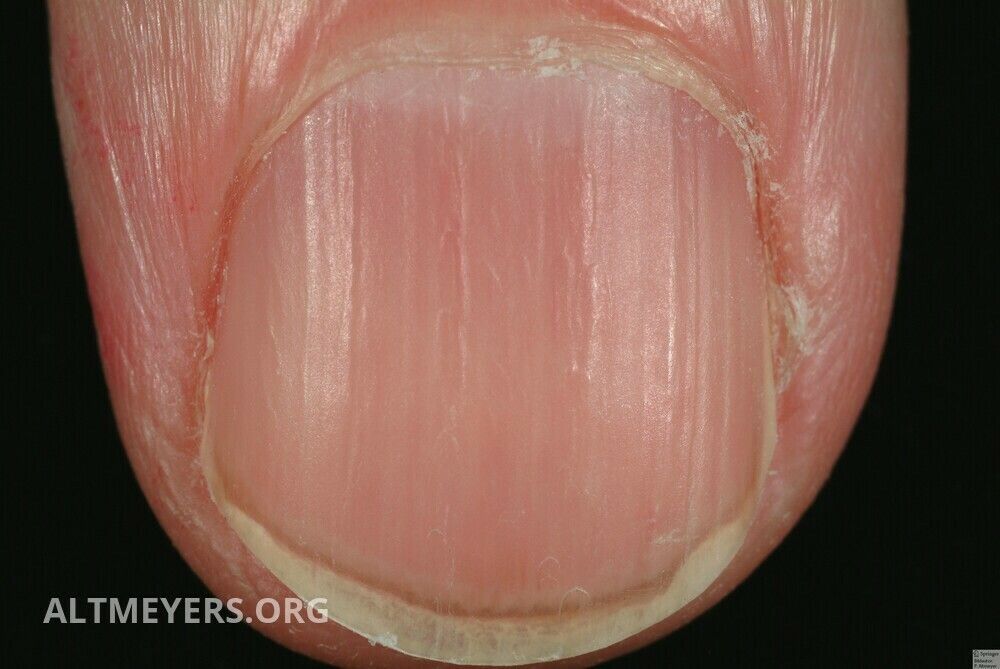 Age nail - Altmeyers Encyclopedia - Department Dermatology Age nail - Altmeyers Encyclopedia - Department Dermatology