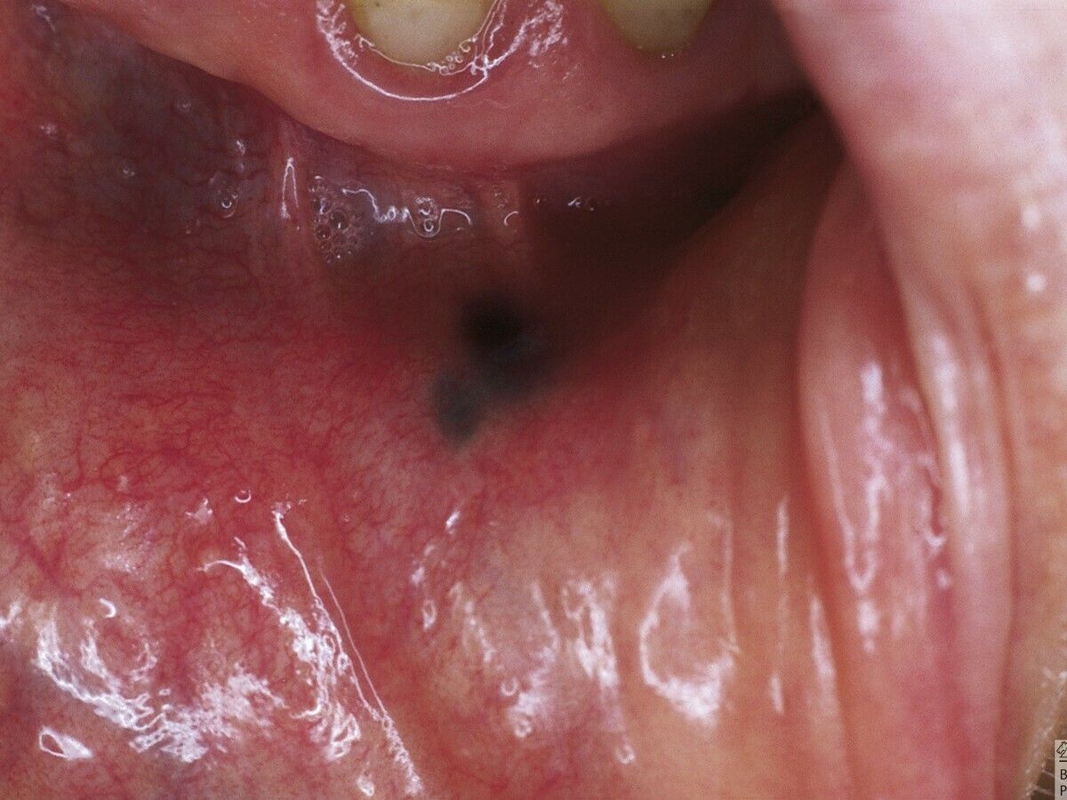 Amalgam tattoo - Altmeyers Encyclopedia - Department Dermatology Amalgam tattoo - Altmeyers Encyclopedia - Department Dermatology