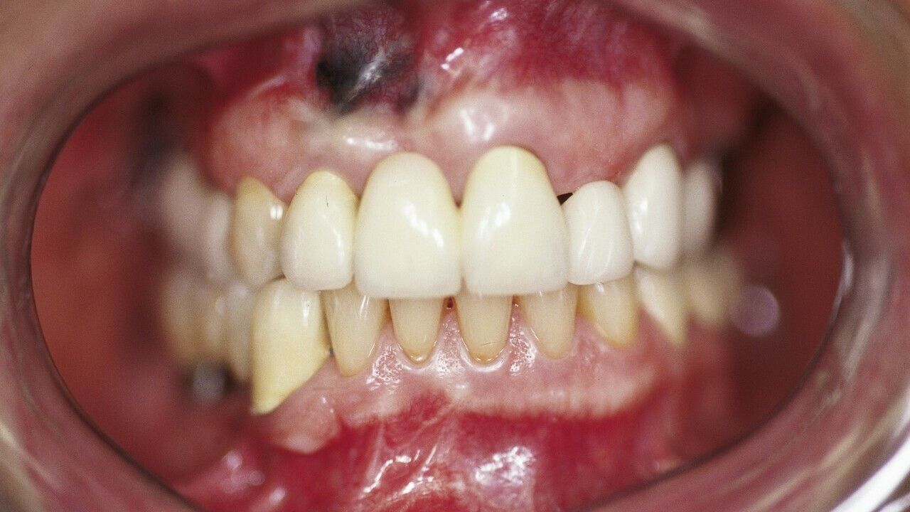 Amalgam tattoo - Altmeyers Encyclopedia - Department Dermatology Amalgam tattoo - Altmeyers Encyclopedia - Department Dermatology