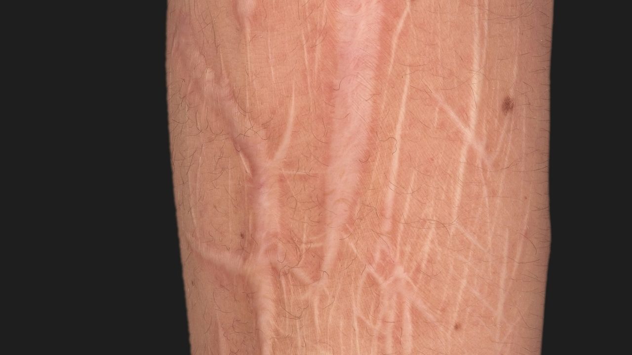 Artefakte Altmeyers Enzyklopadie Fachbereich Dermatologie