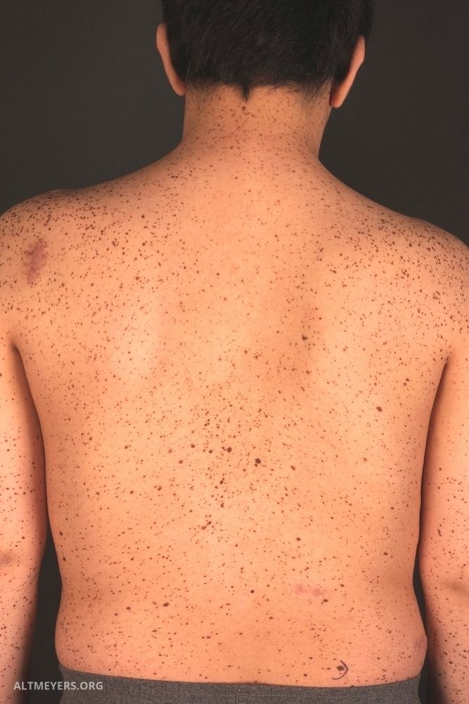 neoplasm malign al găurii de vierme