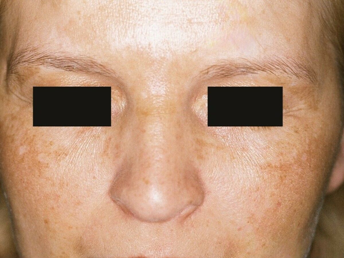 Melasma Altmeyers Enzyklopadie Fachbereich Dermatologie