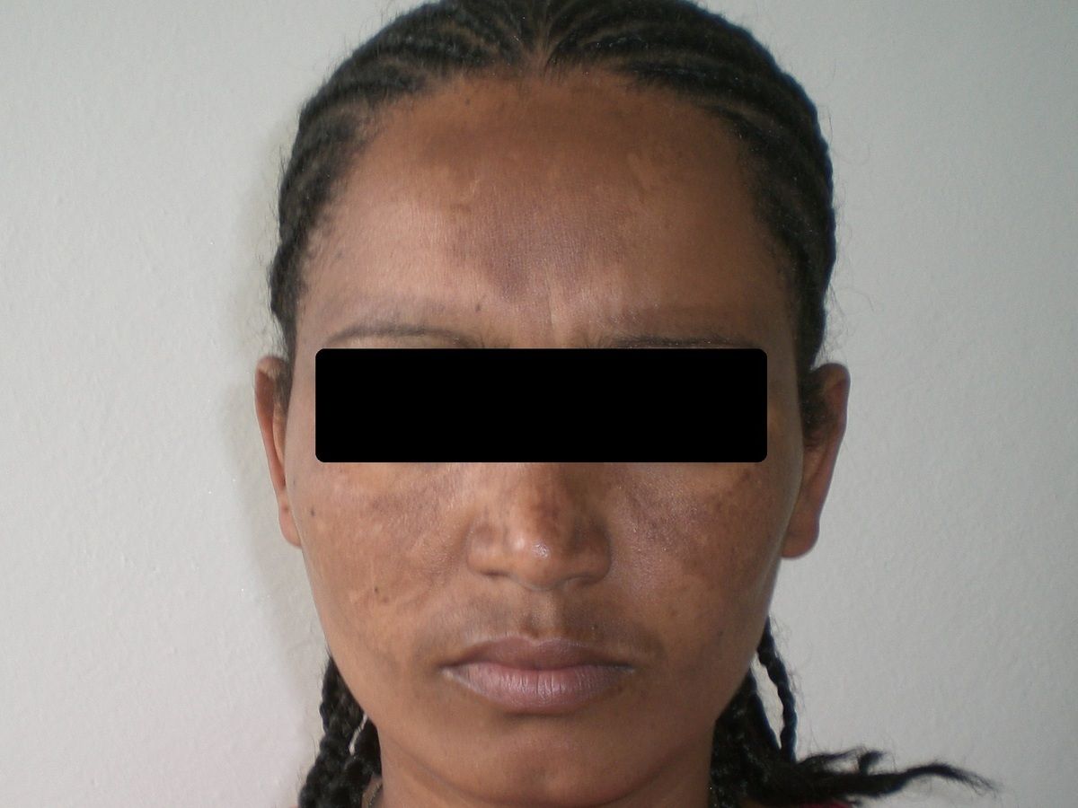 Melasma Altmeyers Enzyklopadie Fachbereich Dermatologie