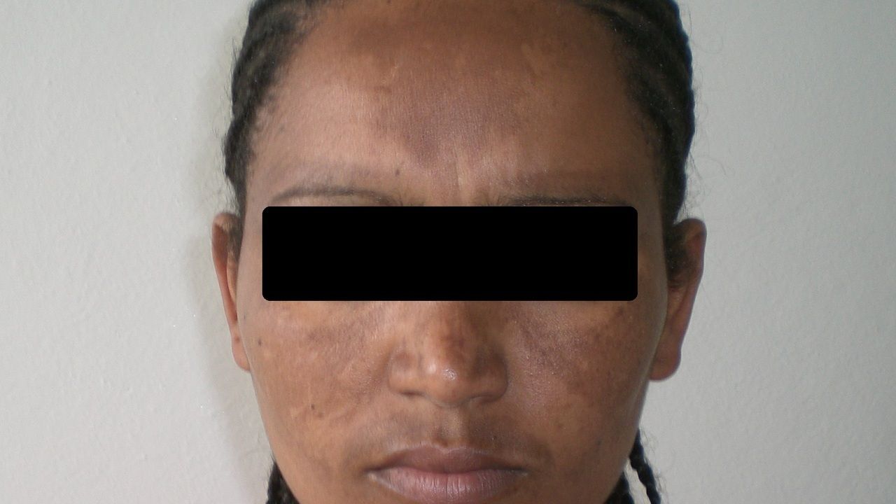 Melasma Altmeyers Enzyklopadie Fachbereich Dermatologie