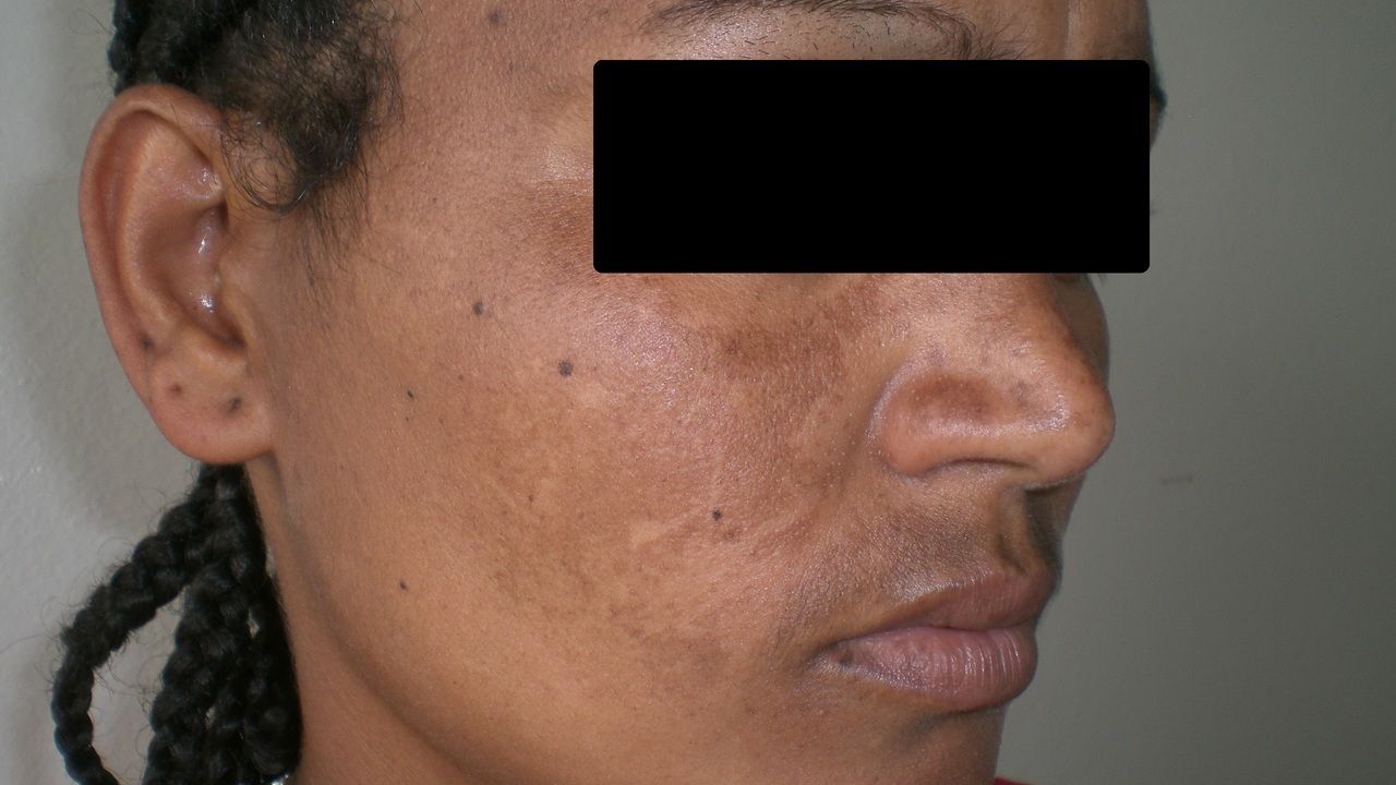 Melasma Altmeyers Enzyklopadie Fachbereich Dermatologie