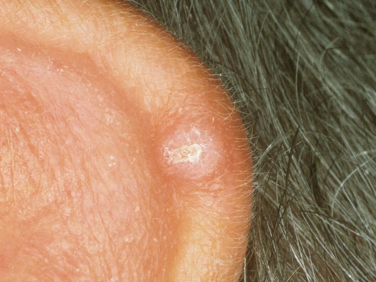 Chondrodermatitis Nodularis Chronica Helicis Altmeyers Enzyklopadie Fachbereich Dermatologie