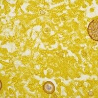 Kokzidioidomykose Bilder Altmeyers Enzyklopädie Fachbereich Innere