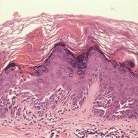 Dyskeratosis follicularis Bilder Altmeyers Enzyklopädie Fachbereich