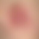 Dermatofibrosarcoma protuberans. Seit vielen Jahren persistierender, langsam wachsender, sehr der...