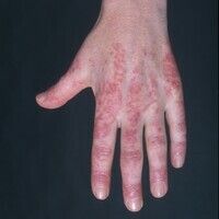 Dermatomyositis (overview) Images - Altmeyers Encyclopedia - Department ...