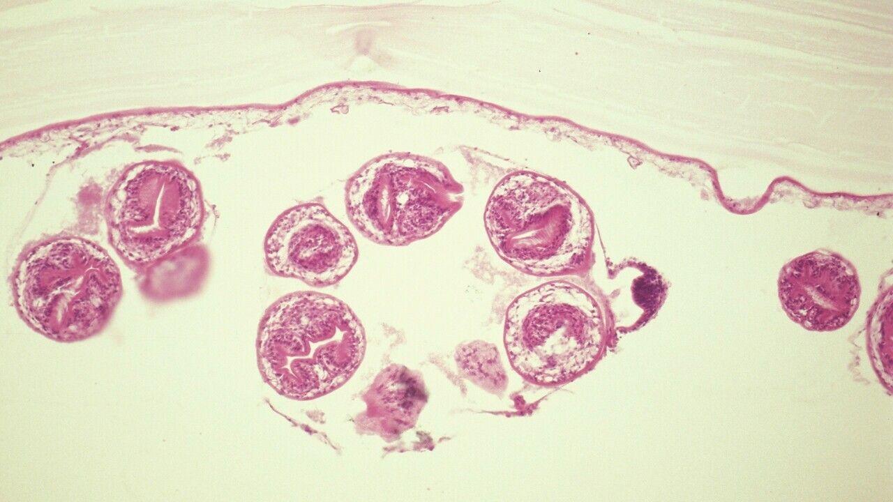 Echinococcus multilocularis Zyste