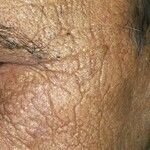 Actinic elastosis - Altmeyers Encyclopedia - Department Dermatology