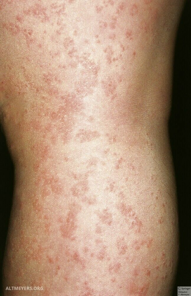 Acrodermatite Papuleuse Infantile De Gianotti Crosti Gianotti Crosti Syndrome In Children