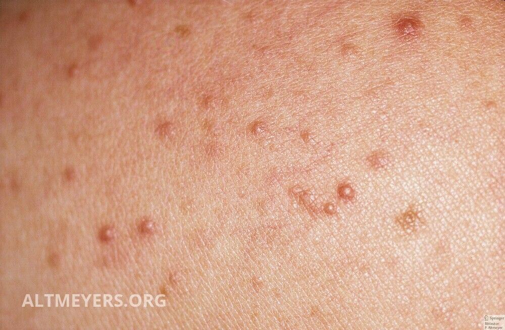pix Mallorcan Acne mallorca acne altmeyers encyclopedia
