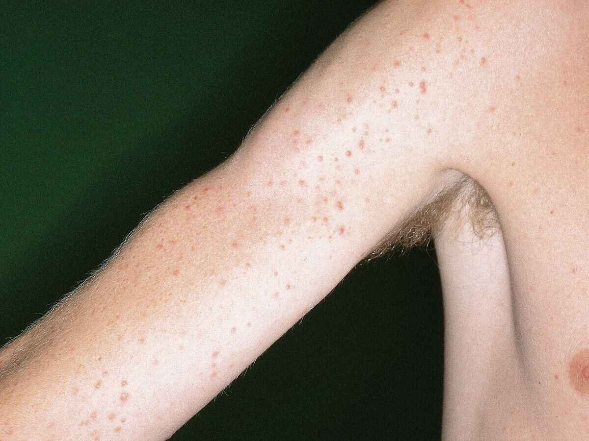 images Mallorcan Acne mallorca acne altmeyers encyclopedia