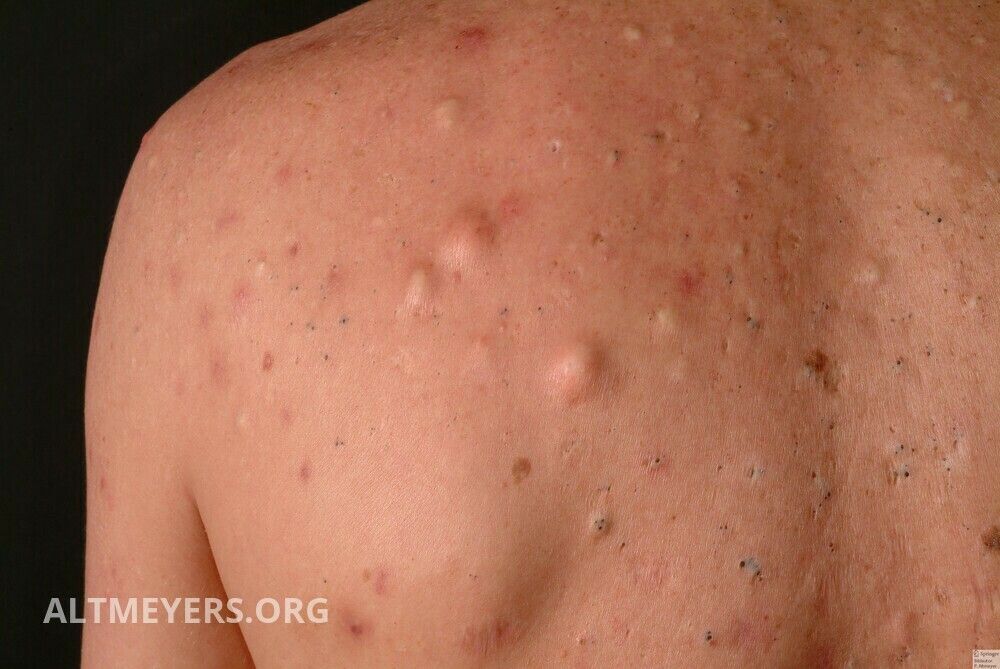 Akne Ubersicht Altmeyers Enzyklopadie Fachbereich Dermatologie