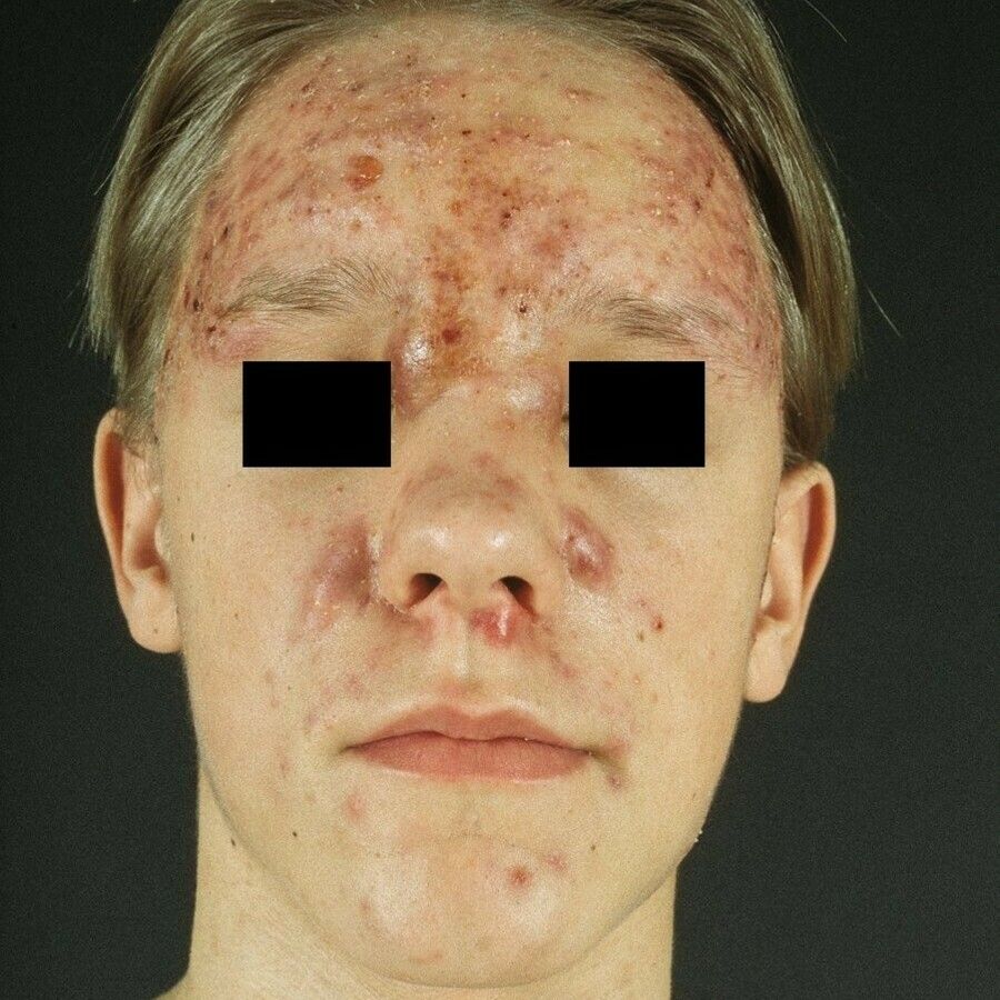 acne fulminans