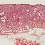 Fibroxanthom atypisches - Altmeyers Enzyklopädie - Fachbereich Dermatologie