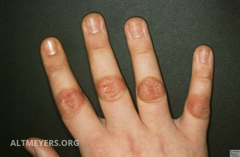 Finger Ankle Pads Real Altmeyers Encyclopedia Department Dermatology