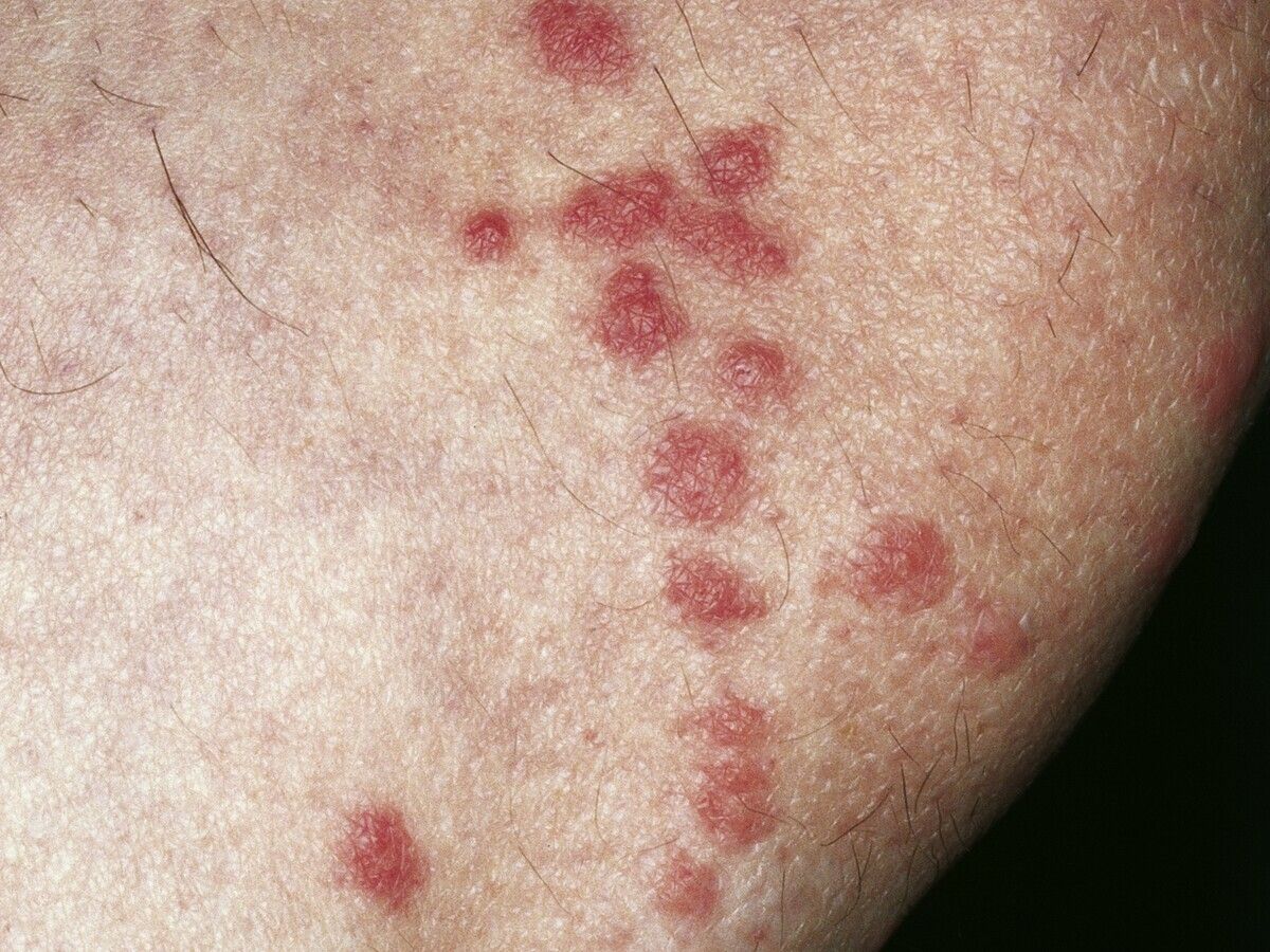 Flohstich Altmeyers Enzyklopadie Fachbereich Dermatologie