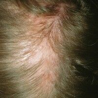 Folliculitis decalvans Images - Altmeyers Encyclopedia - Department ...