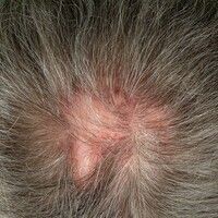 Folliculitis decalvans Images - Altmeyers Encyclopedia - Department ...