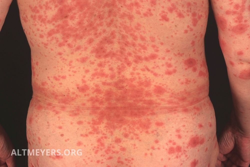 Erythema Multiforme Minor