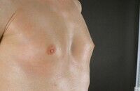 Prostatitis húzza hogyan kezelik a prosztata adenoma