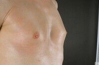 Gynecomastia a prostatitis alatt