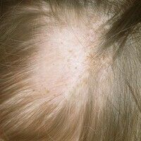 Loses Anagenhaar-Syndrom Images - Altmeyers Encyclopedia - Department ...