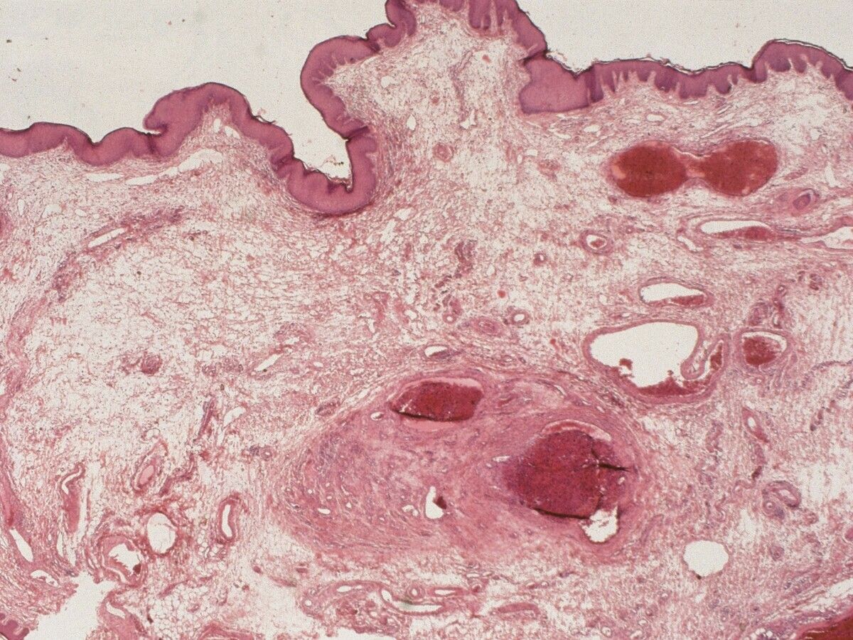 Analvenenthrombose Akute Altmeyers Enzyklopadie Fachbereich Dermatologie