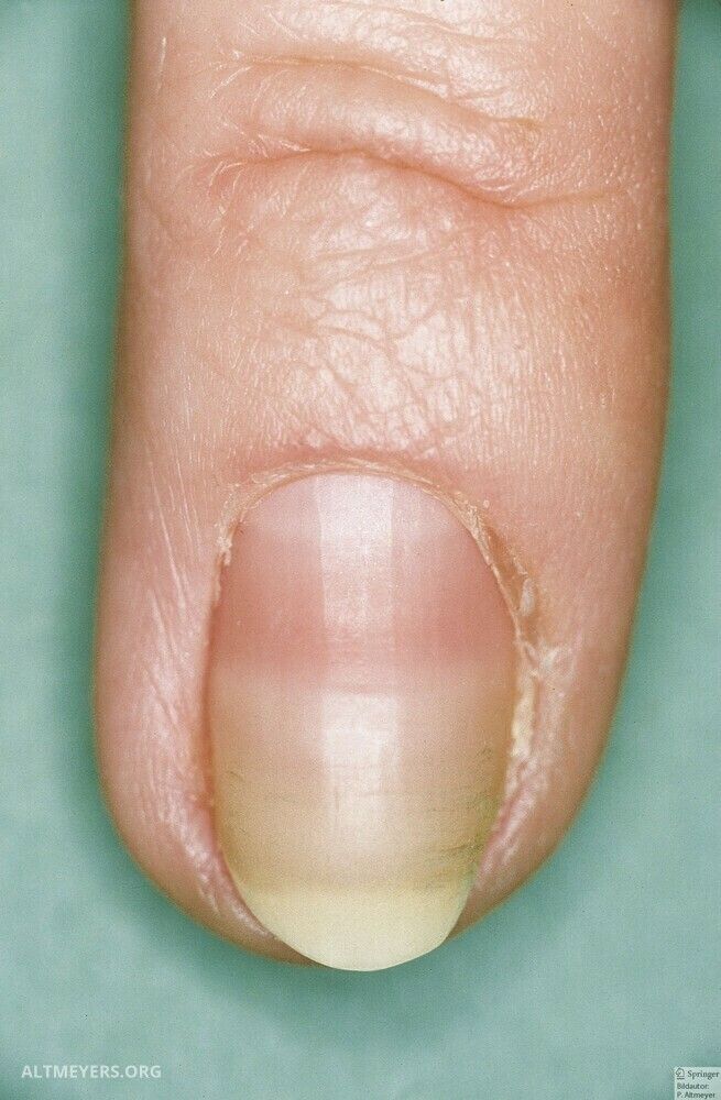 Half-and-half nails - Altmeyers Encyclopedia - Department Dermatology Half-and-half nails - Altmeyers Encyclopedia - Department Dermatology