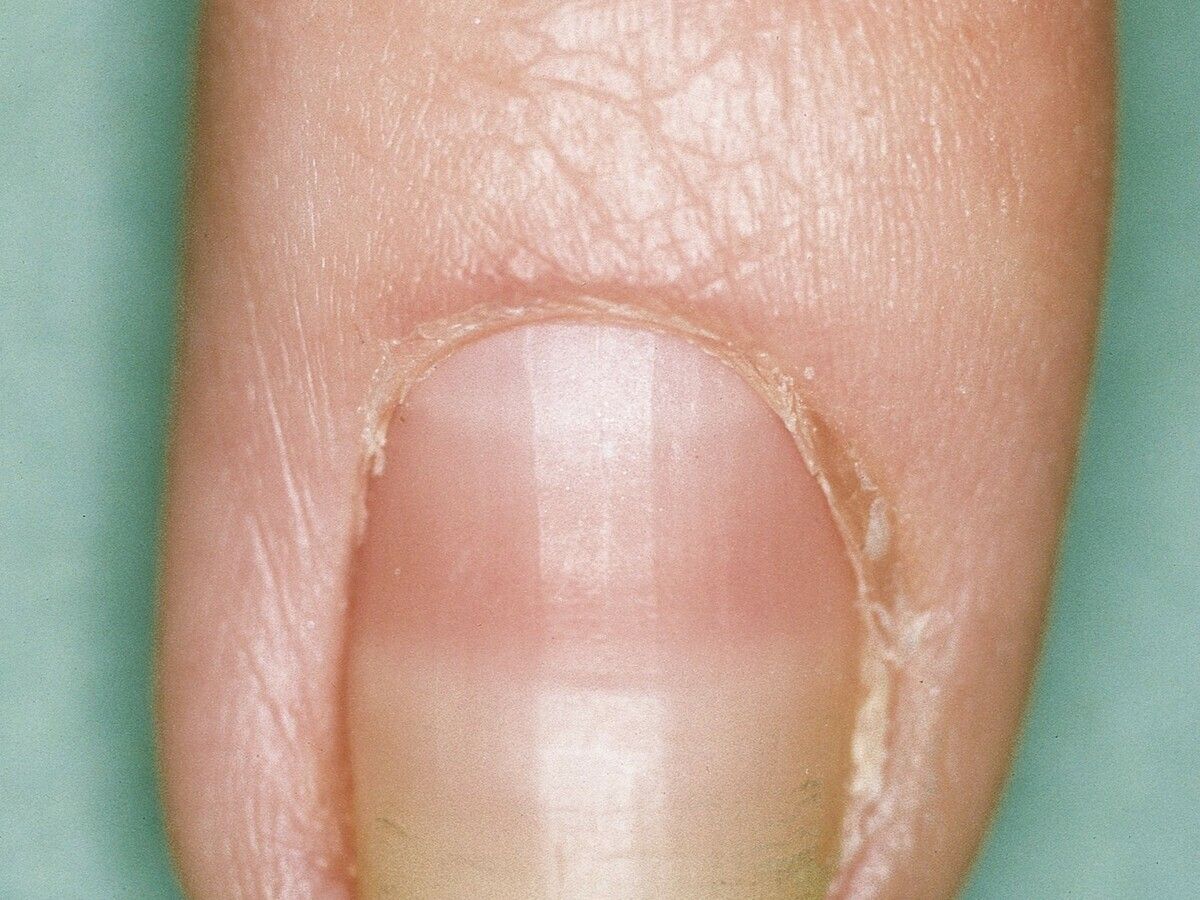 Half And Half Nails Altmeyers Encyclopedia Department Dermatology