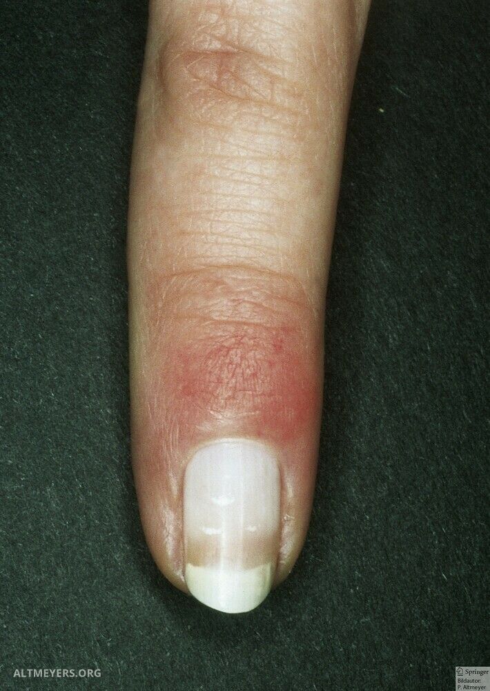 Half And Half Nails Altmeyers Encyclopedia Department Dermatology Half And Half Nails Altmeyers Encyclopedia Department Dermatology