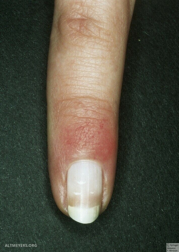 Half And Half Nails Altmeyers Encyclopedia Department Dermatology