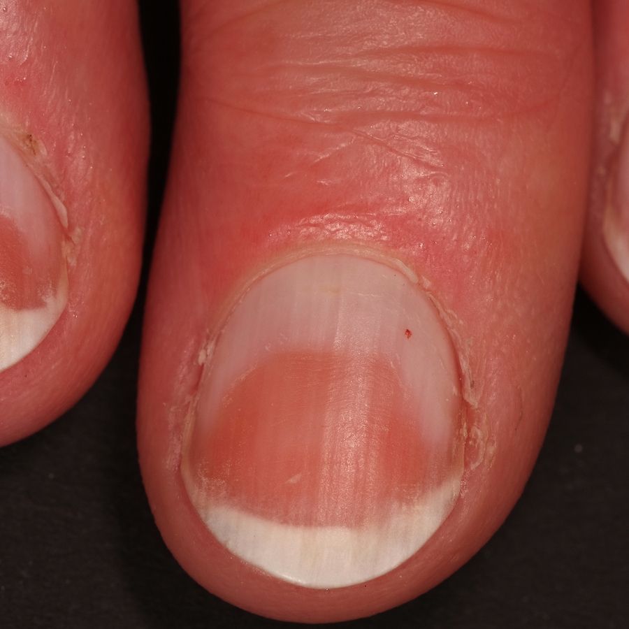 Half And Half Nails Altmeyers Encyclopedia Department Dermatology