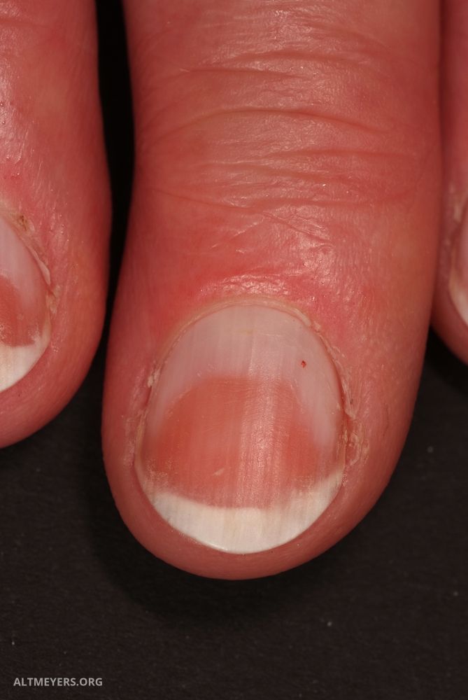 Half And Half Nails Altmeyers Encyclopedia Department Dermatology