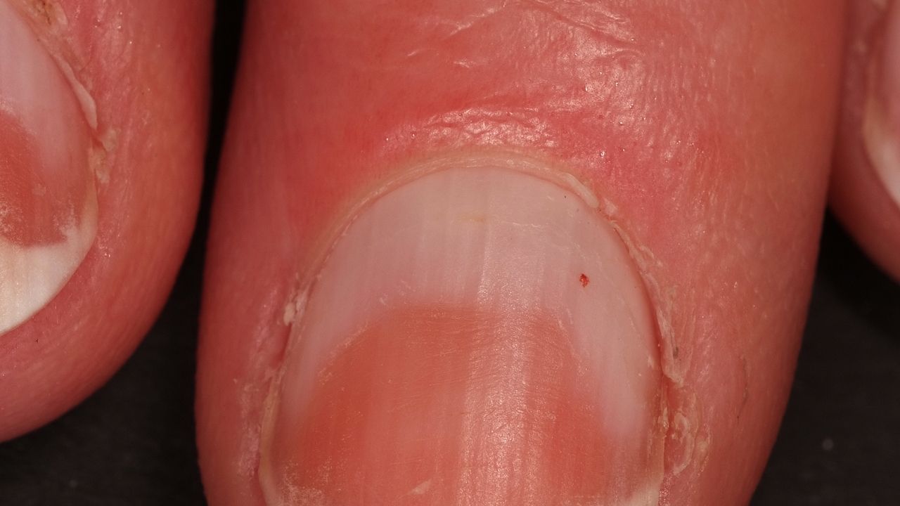 Half And Half Nails Altmeyers Encyclopedia Department Dermatology Half And Half Nails Altmeyers Encyclopedia Department Dermatology