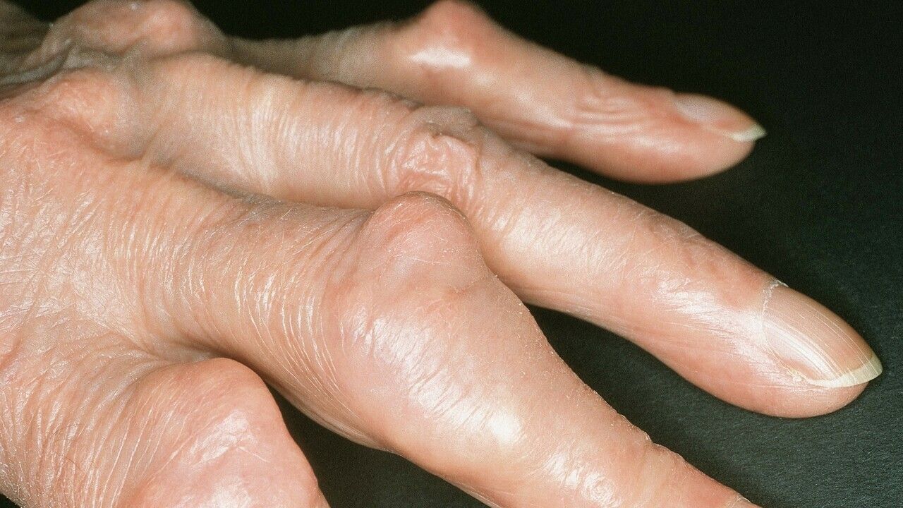 Knubbel finger Schwellungen und