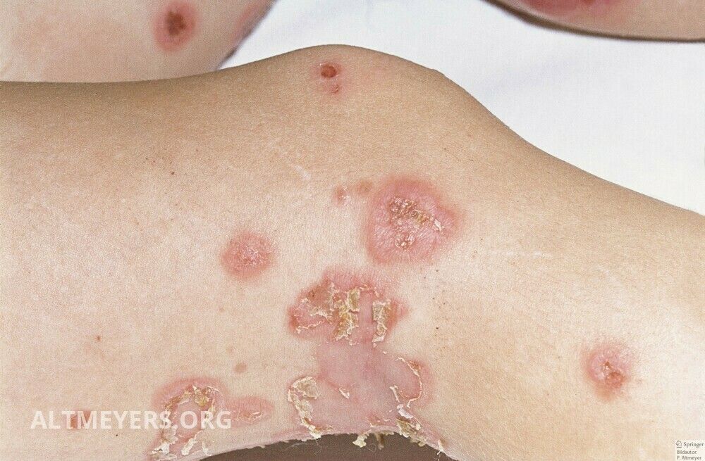 Impetigo Contagiosa Altmeyers Enzyklopadie Fachbereich Dermatologie