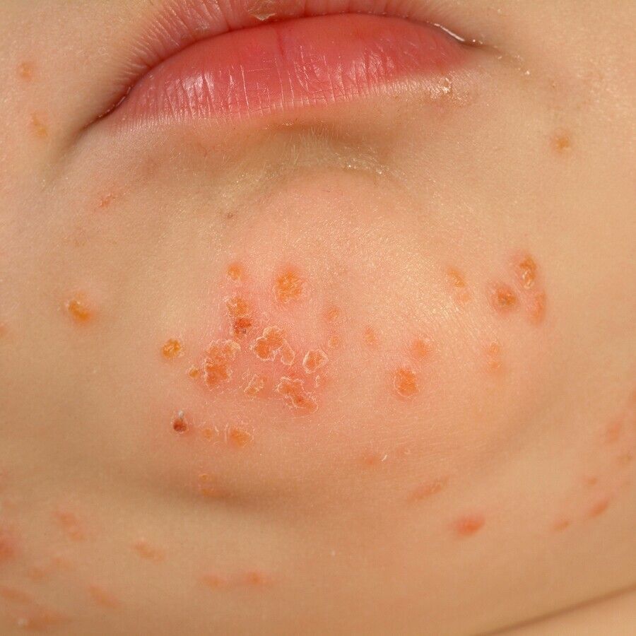 Impetigo Contagiosa Altmeyers Enzyklopadie Fachbereich Dermatologie