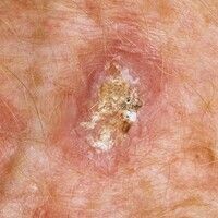 Squamous cell carcinoma of the skin Images - Altmeyers Encyclopedia ...