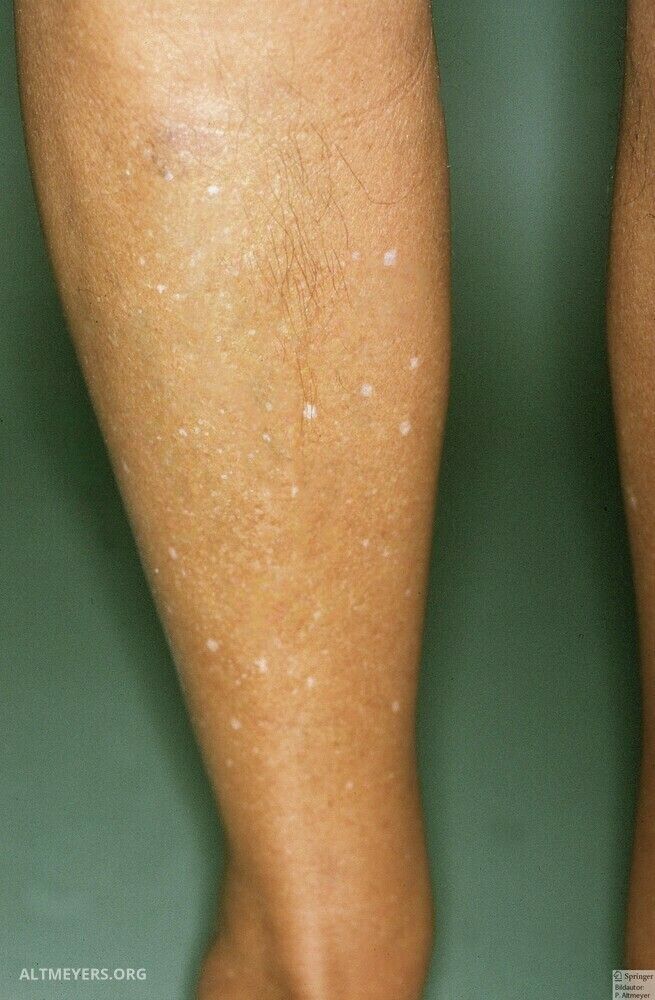Hypomelanosis hypomelanosis
