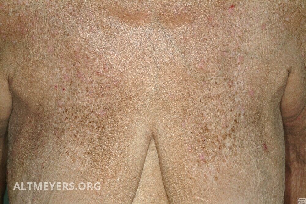 Ichthyosis Vulgaris Autosomal Dominante Altmeyers Enzyklopadie Fachbereich Dermatologie