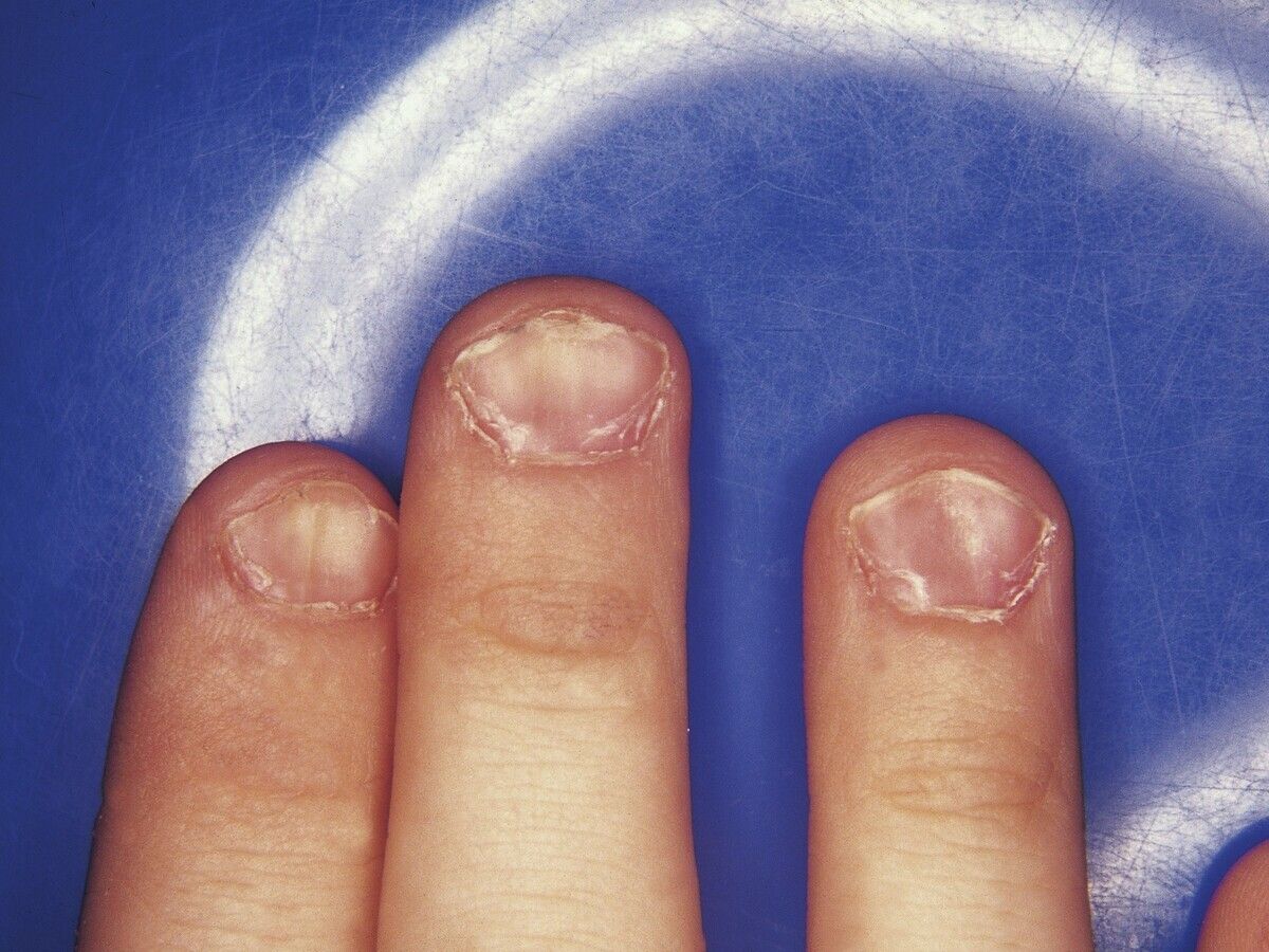 Koilonychie - Altmeyers Encyclopedia - Department Dermatology Koilonychie - Altmeyers Encyclopedia - Department Dermatology