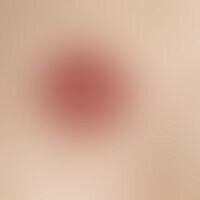 Keratoacanthoma: Rapidly growing red lump on normal skin with a wall-like raised edge enclosing a...